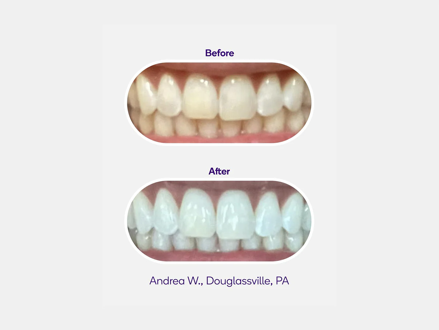 Non-Slip Whitening Strips (PAP) - Image 2