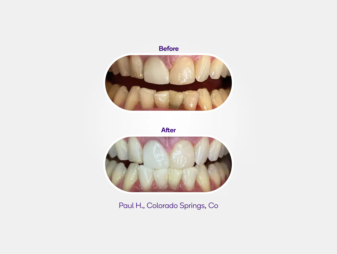 Prefilled Whitening Trays 3 pack Refill - Image 4
